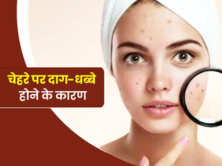 Dark Spots on Face: चेहरे पर क्यों होते हैं काले दाग-धब्बे? एक्सपर्ट से जानें बचाव के टिप्स 