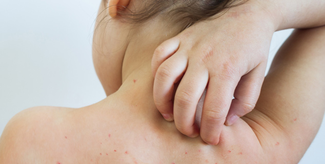 rashes_measles