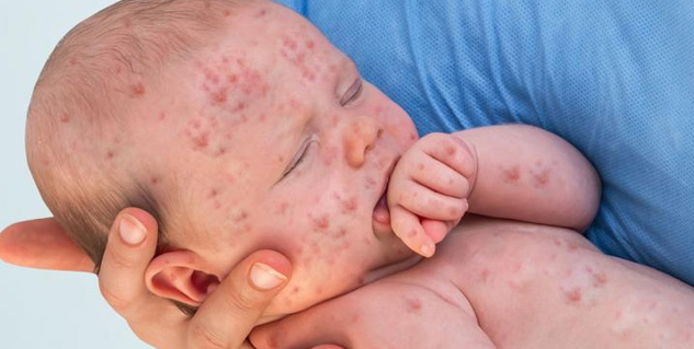 measles_in_children