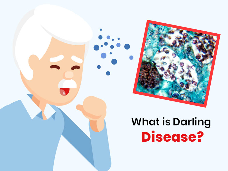 What Is Darling Disease? Know Symptoms, Causes, Risk Factors And Complications