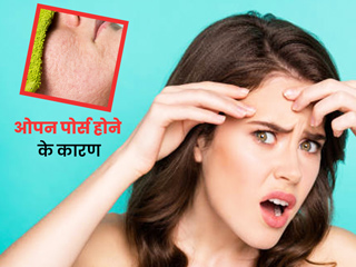 स्किन पर गड्ढे (ओपन पोर्स) क्यों हो जाते हैं? एक्सपर्ट से जानें इसके कारण और बचाव के उपाय