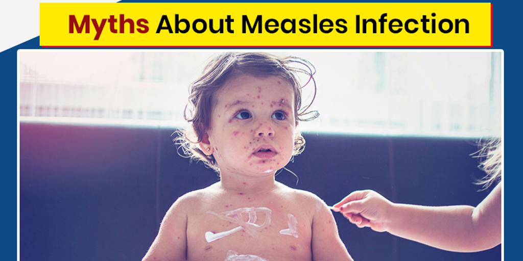 Measles Infection: 8 Myths And Facts | Onlymyhealth