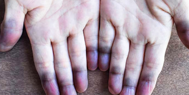 peripheral cyanosis