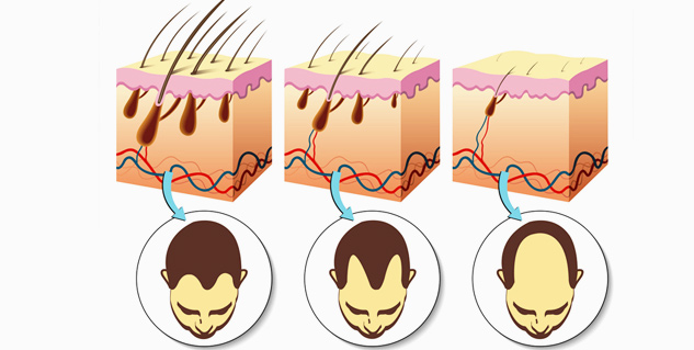 Insidedhtandbaldness