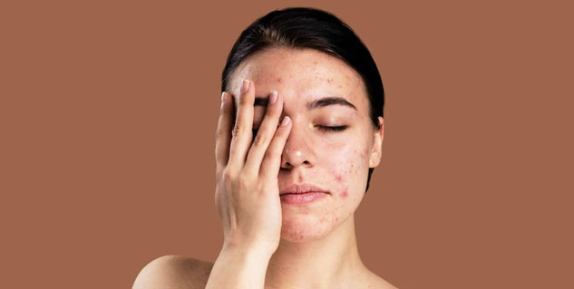Eczema-acne