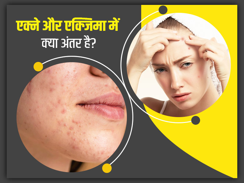 चेहरे पर लाल दाने एक्ने (मुहांसे) हैं या एक्जिमा? जानें दोनों में अंतर और इन्हें ठीक करने के उपाय