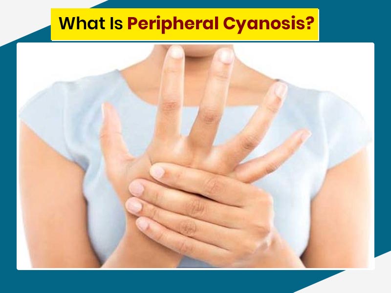 Peripheral Cyanosis (Blue Hands and Feet): Causes and More