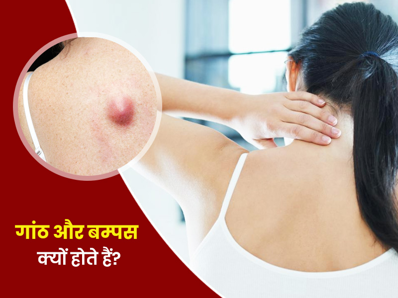 त्वचा पर गांठ और बम्पस क्यों होते हैं? जानें इनके लक्षण और कारण  