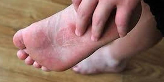 Foot-rashes