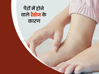 पैरों में होने वाले रैशेज किन कारणों से होता है? जानें इससे बचाव के उपाय