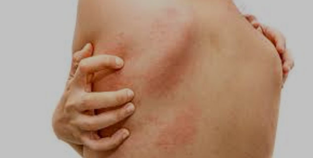 Bacterial-infection