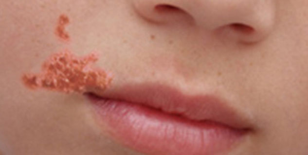 Bacterial-infection