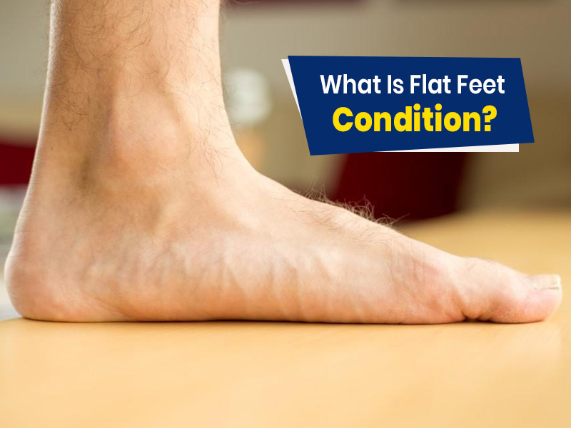 Flat Feet: Symptoms, Causes And Risks