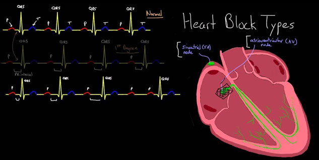 types of heart blockage