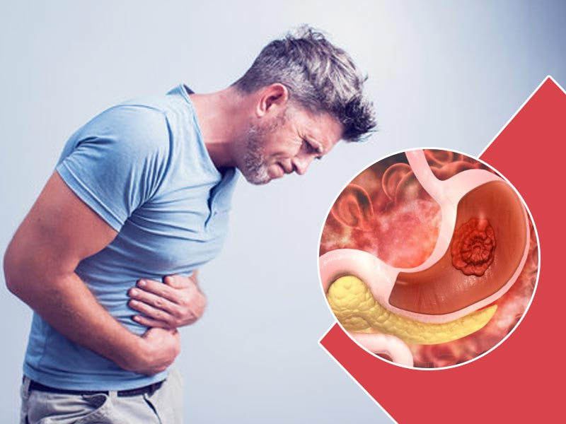 पेट में ट्यूमर का इलाज क्या है? जानें डॉक्टर से