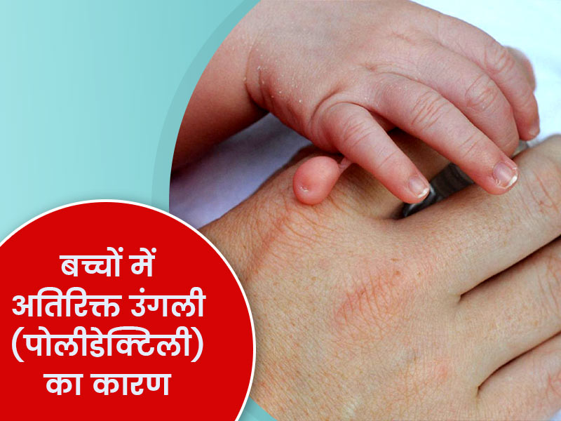 बच्चों का अतिरिक्त उंगली के साथ जन्म (Polydactyly) का कारण, लक्षण औप उपाय 