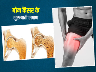 बोन कैंसर होने से पहले शरीर में दिखाई देते हैं ये 6 लक्षण, डॉक्टर से जानें इनके बारे में