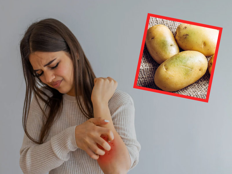 Potato allergy: आलू से एलर्जी के कारण हो सकते हैं रैशेज या खुजली, जानें इसके अन्‍य लक्षण और उपाय