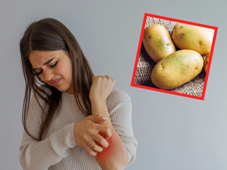 Potato allergy: आलू से एलर्जी के कारण हो सकते हैं रैशेज या खुजली, जानें इसके अन्‍य लक्षण और उपाय
