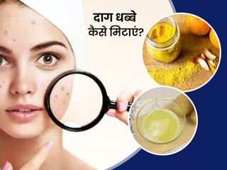 मुहांसों के दाग धब्बे कैसे हटाएं: इन 5 फेस पैक से मिटाएं एक्ने और पिंपल्स के दाग, त्वचा बनेगी बेदाग