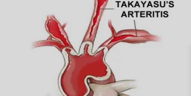 artery-disease