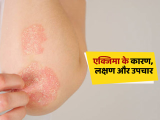 इन कारणों से हो सकता है आपको एक्जिमा (खुजली) की समस्या, जानें इसके लक्षण और बचाव के उपाय