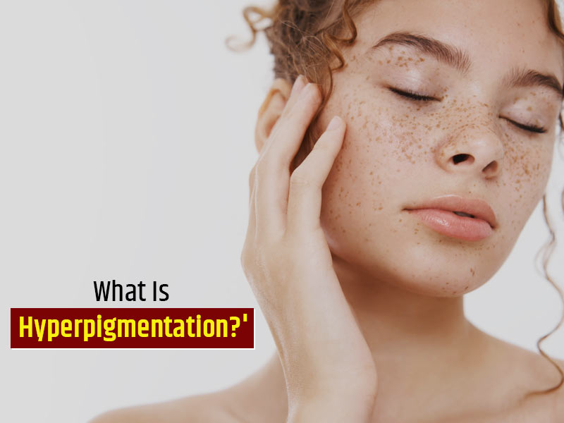 Dark Patches On Skin? It Could Be Hyperpigmentation. Know What It Is
