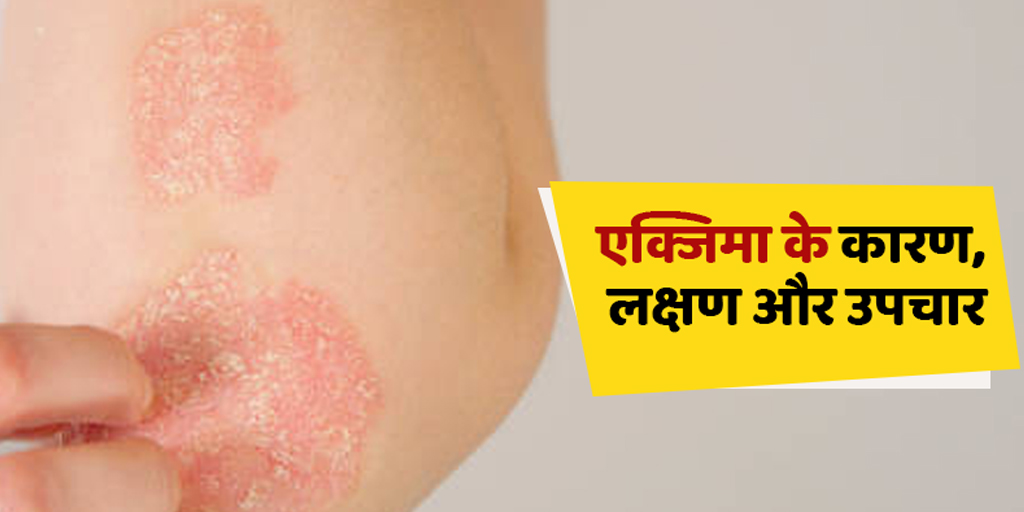 Eczema in Hindi एक्जिमा के कारण लक्षण और उपचार Eczema in Hindi