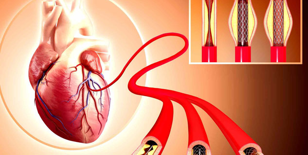 heart stent