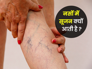 नसों में सूजन क्यों आती है? जानें इसके कारण और बचाव के उपाय
