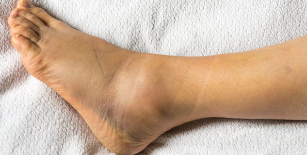 swollen_ankles_feet