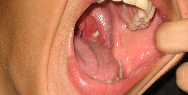 tonsil stone