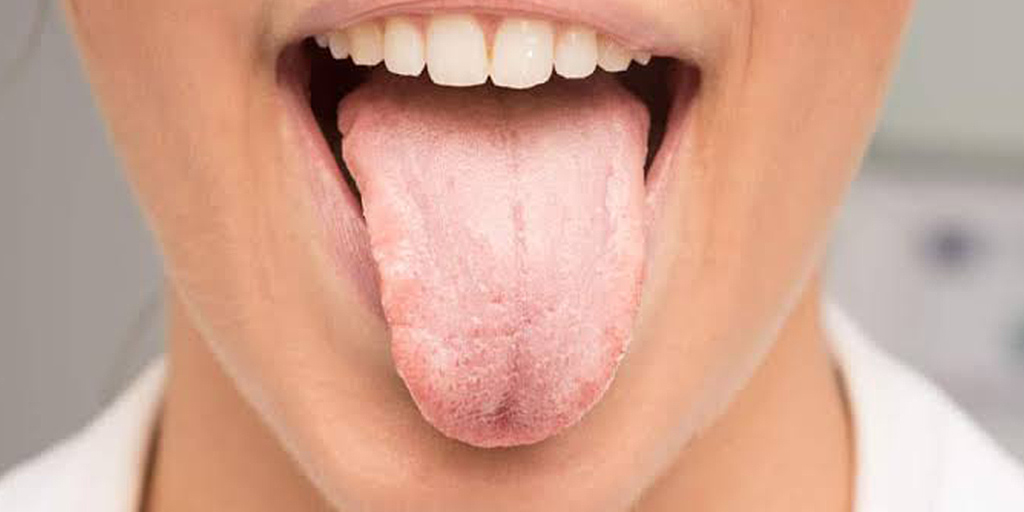 Dry Mouth Symptoms Causes And Treatment Onlymyhealth 1409