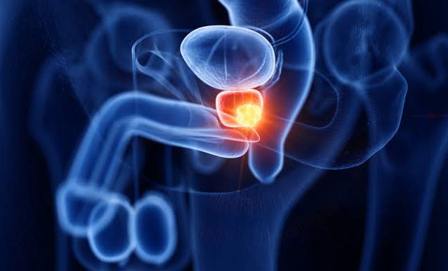 how-prostate-cancer-affects-men-in-india-new-advancements-in-diagnosis