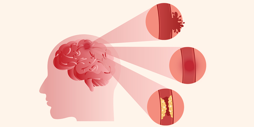 What Is The Meaning Of Brain Stroke In Hindi