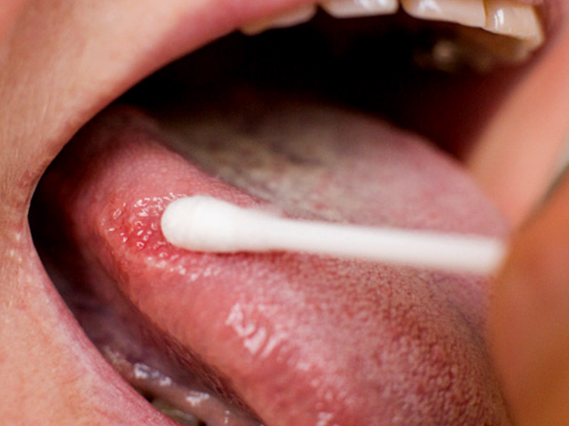 मुंह के अंदर सफेद पर्त या धब्बे (ल्यूकोप्लाकिया) होने के कारण, लक्षण और बचाव