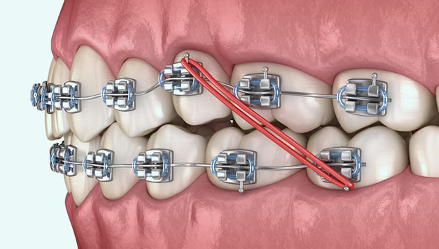 Orthodontics: Types Of Dental Treatment For Relief