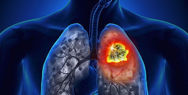lung cancer treatment in hindi