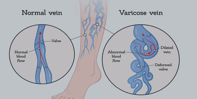 varicose veins