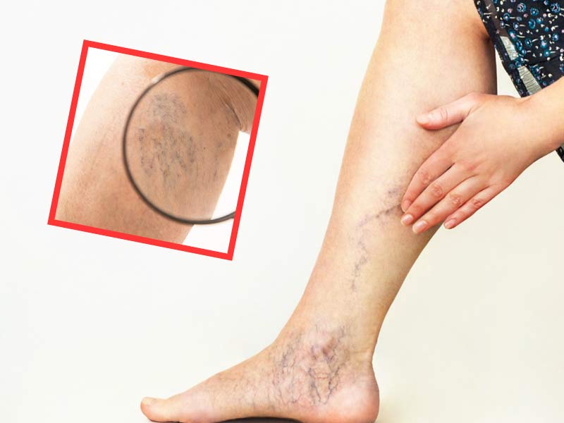 Varicose Veins: पैर में उभरी हुई नीली नसें हैं वेरिकोज वेन्स, जानें इसके 5 कारण, लक्षण और इलाज