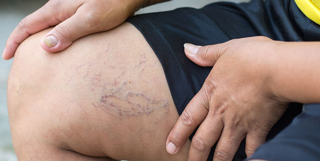 varicose veins causes