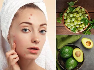 मुहांसों से छुटकारा पाना चाहते हैं तो पिएं ये 5 हर्बल ड्रिंक्स, सेहत को मिलेंगे कई और फायदे