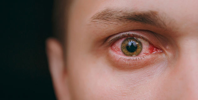 Ocular-Hypertension