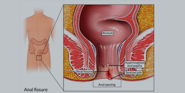 Difference Between Piles And Fissures Know More About These Conditions Onlymyhealth