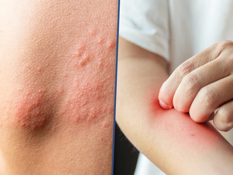 atopic dermatitis causes