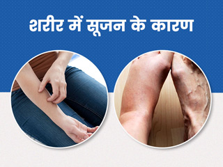 शरीर में सूजन क्यों आती है? डॉक्टर से जानें इसके 6 कारण और बचाव के उपाय