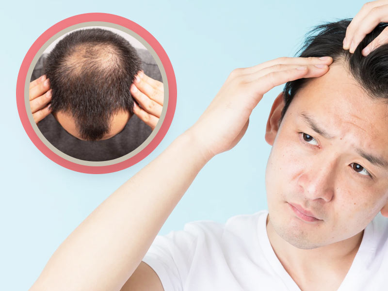 Hair loss in teenage male causes in hindi | पुरुषों में कम उम्र में बाल  झड़ने के 5 कारण