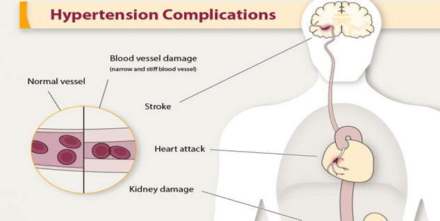 hypertension causes
