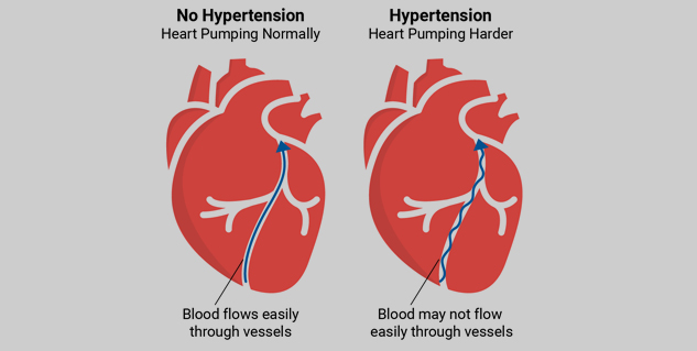 hypertension treatment
