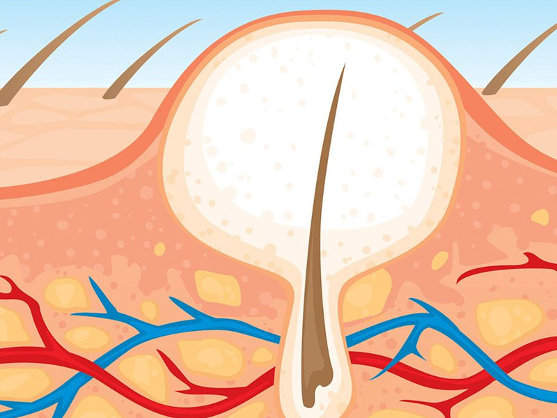 Follow These Simple Tricks To Eliminate And Prevent Ingrown Hair